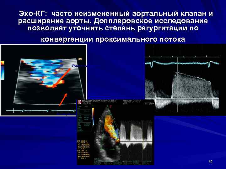 Эхокардиография с допплеровским анализом