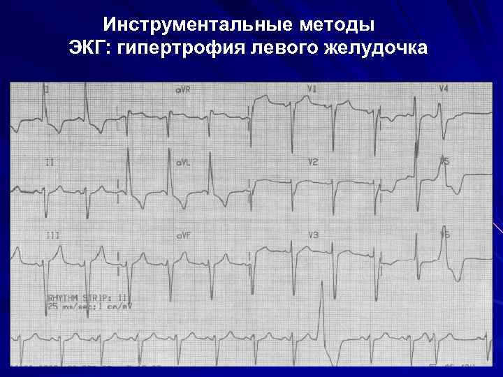 Инструментальные методы ЭКГ: гипертрофия левого желудочка 83 