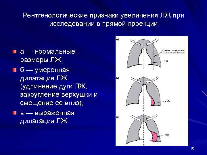 Рентгенологические признаки увеличения ЛЖ при исследовании в прямой проекции а — нормальные размеры ЛЖ;