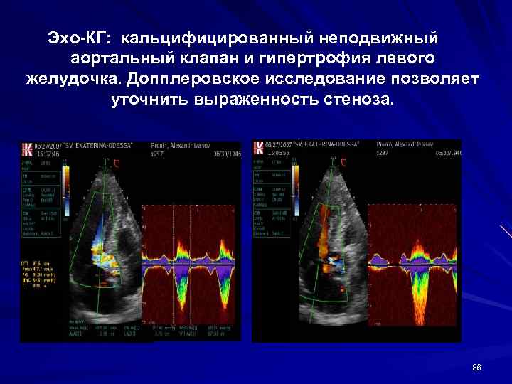 Эхо-КГ: кальцифицированный неподвижный аортальный клапан и гипертрофия левого желудочка. Допплеровское исследование позволяет уточнить выраженность