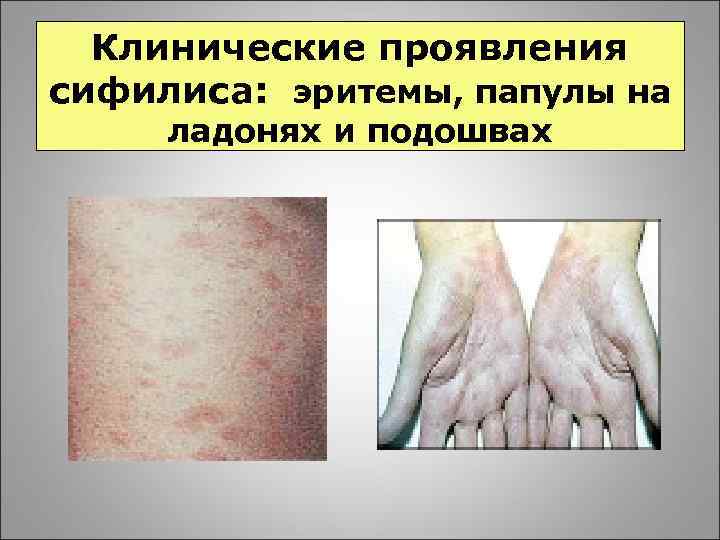 Клинические проявления сифилиса: эритемы, папулы на ладонях и подошвах 
