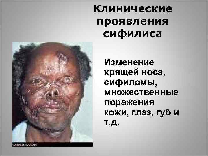 Клинические проявления сифилиса Изменение хрящей носа, сифиломы, множественные поражения кожи, глаз, губ и т.