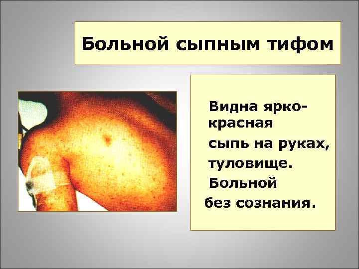 Больной сыпным тифом Видна яркокрасная сыпь на руках, туловище. Больной без сознания. 