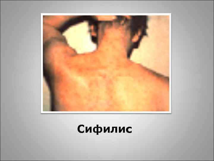 Сифилис 