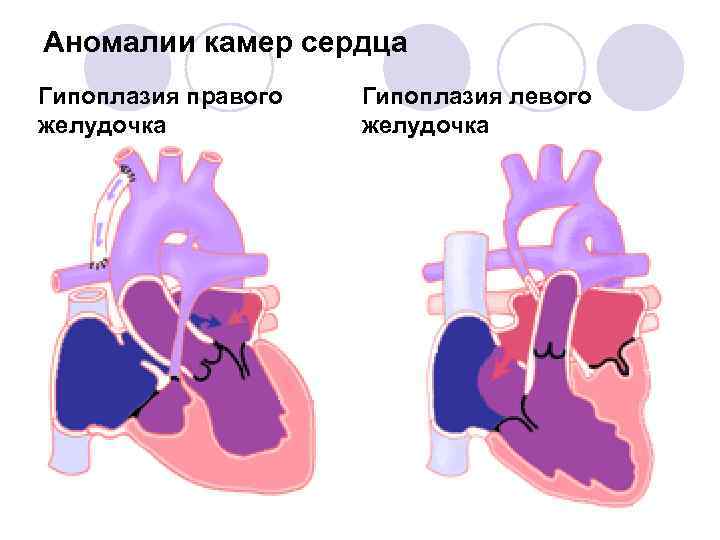 Аномалии камер сердца Гипоплазия правого желудочка Гипоплазия левого желудочка 