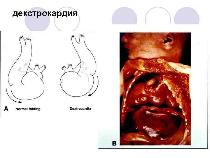 декстрокардия 