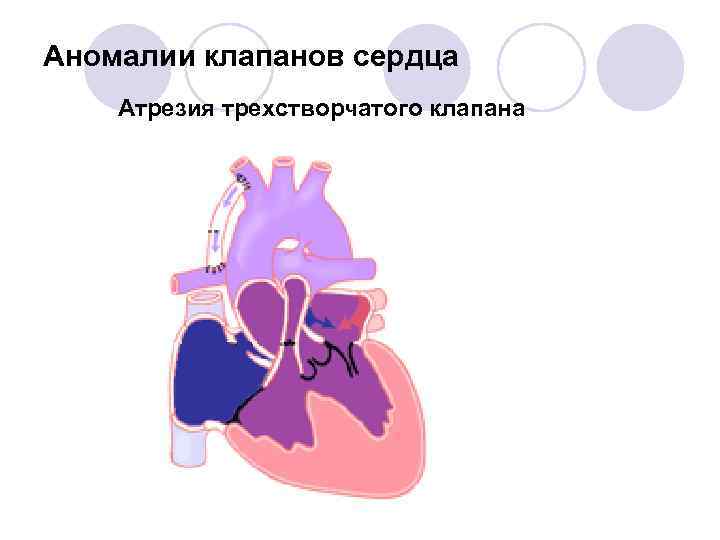 Атрезия трехстворчатого клапана презентация