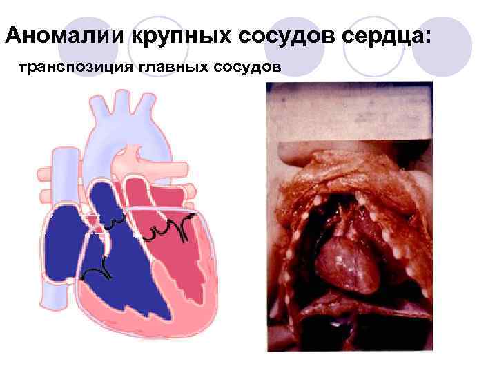 Аномалии крупных сосудов сердца: транспозиция главных сосудов 