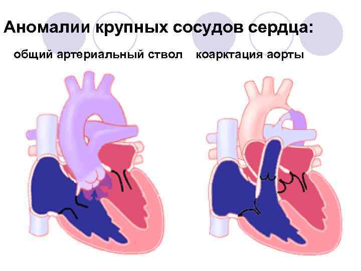 Аномалии крупных сосудов сердца: общий артериальный ствол коарктация аорты 
