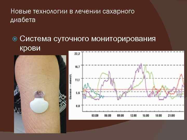 Новые технологии в лечении сахарного диабета Система суточного мониторирования крови 