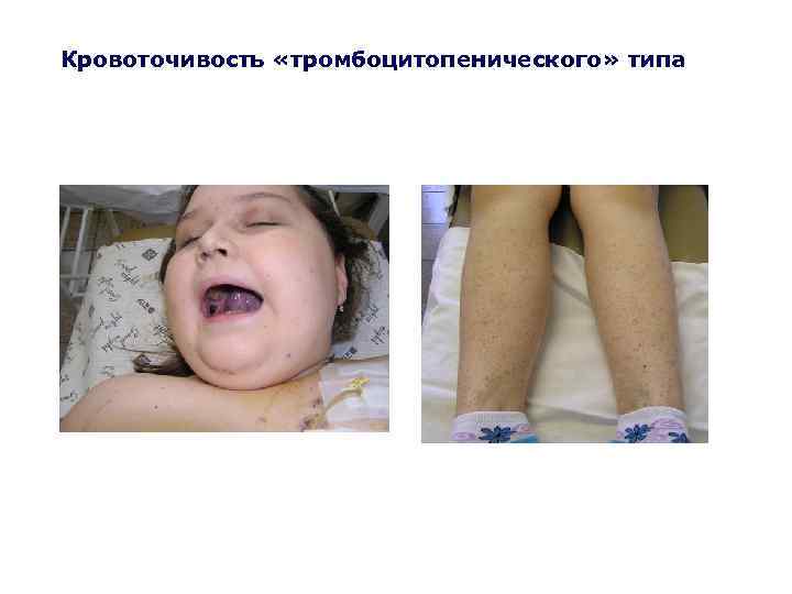 Кровоточивость «тромбоцитопенического» типа 
