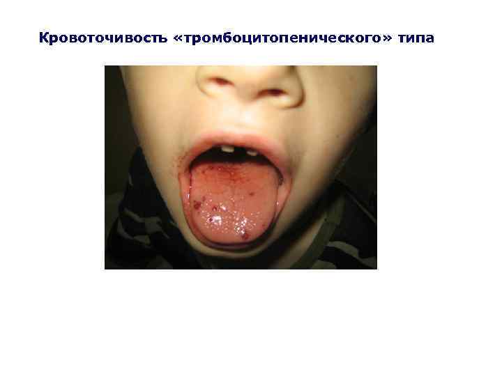 Кровоточивость «тромбоцитопенического» типа 