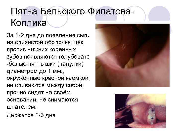 Пятна Бельского-Филатова. Коплика За 1 -2 дня до появления сыпи на слизистой оболочке щёк