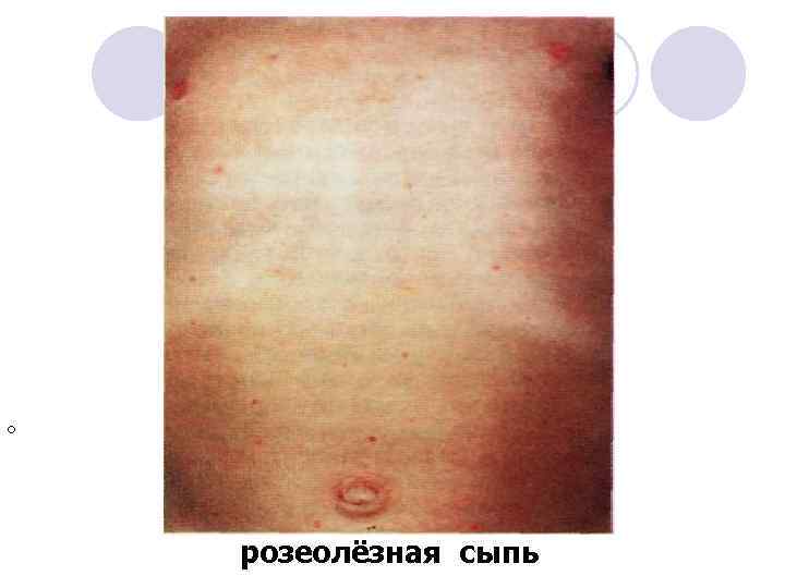 О розеолёзная сыпь 