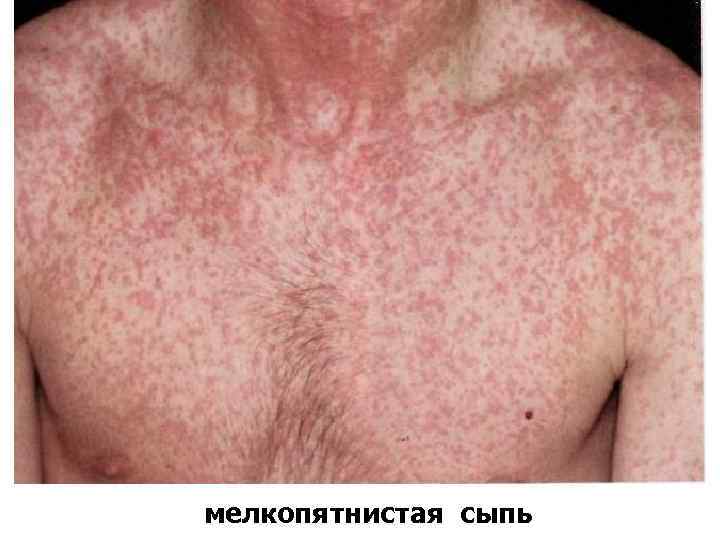 мелкопятнистая сыпь 