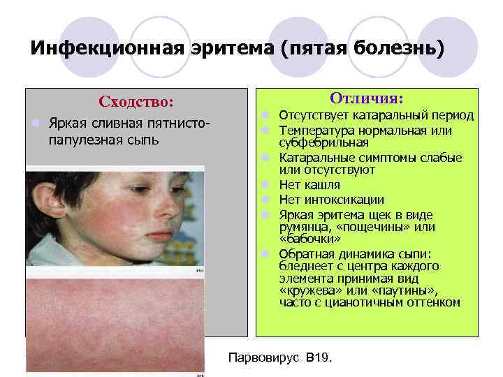 Инфекционная эритема (пятая болезнь) Сходство: l Яркая сливная пятнистопапулезная сыпь Отличия: l Отсутствует катаральный