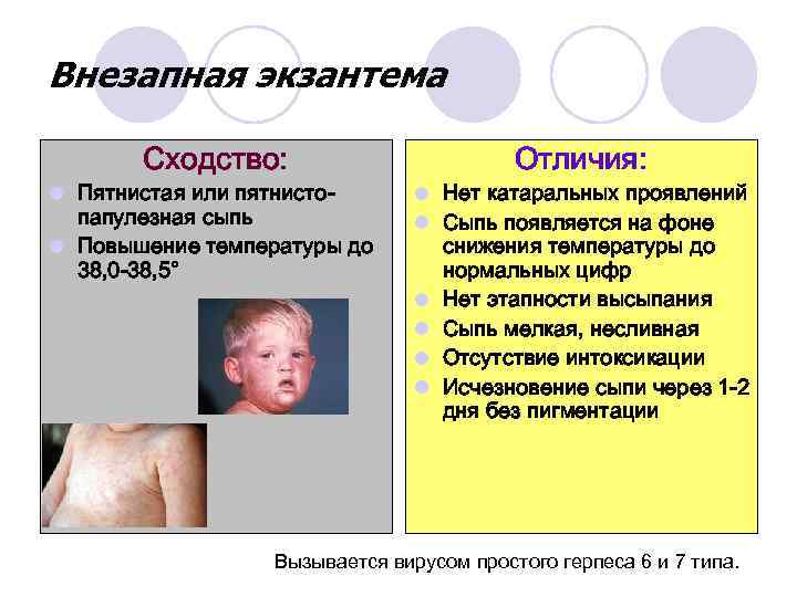 Внезапная экзантема Сходство: l Пятнистая или пятнистопапулезная сыпь l Повышение температуры до 38, 0