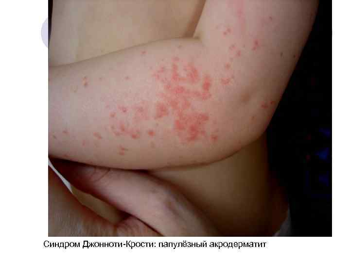 Синдром Джонноти-Крости: папулёзный акродерматит 