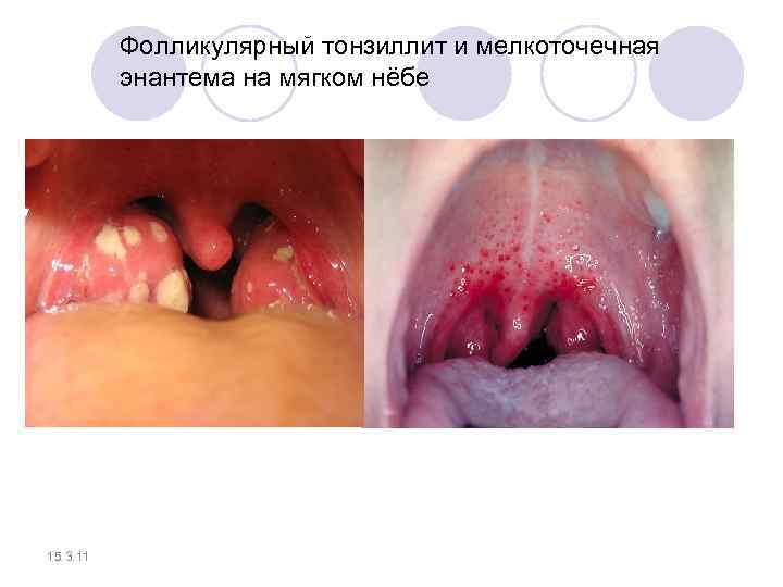 Фолликулярный тонзиллит и мелкоточечная энантема на мягком нёбе 15. 3. 11 
