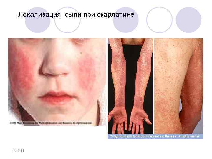  Локализация сыпи при скарлатине 15. 3. 11 