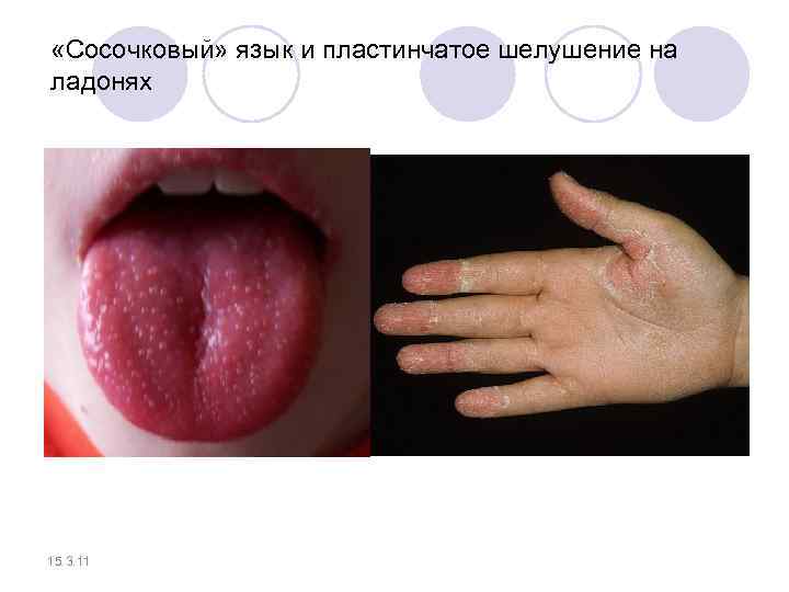  «Сосочковый» язык и пластинчатое шелушение на ладонях 15. 3. 11 