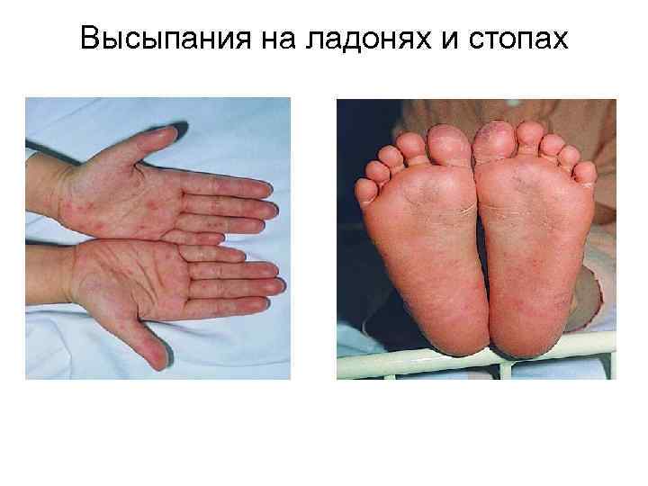 Высыпания на ладонях и стопах 