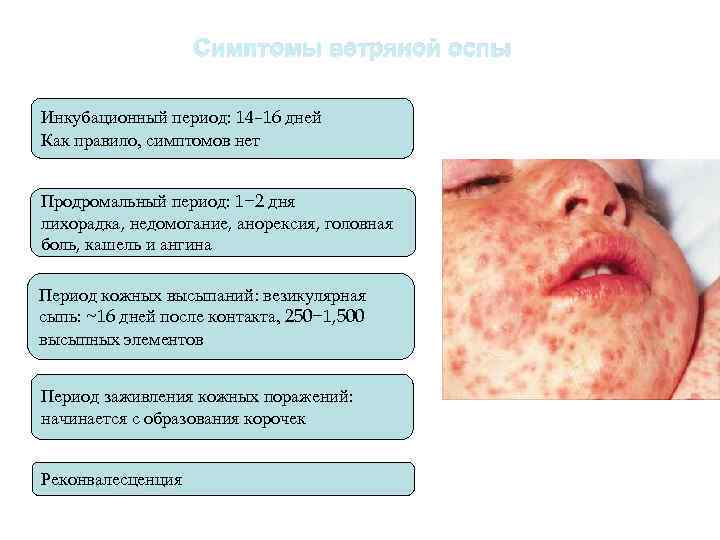 Симптомы ветряной оспы Инкубационный период: 14– 16 дней Как правило, симптомов нет Продромальный период: