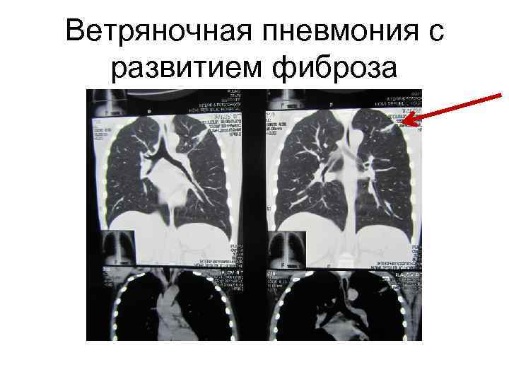 Ветряночная пневмония с развитием фиброза 