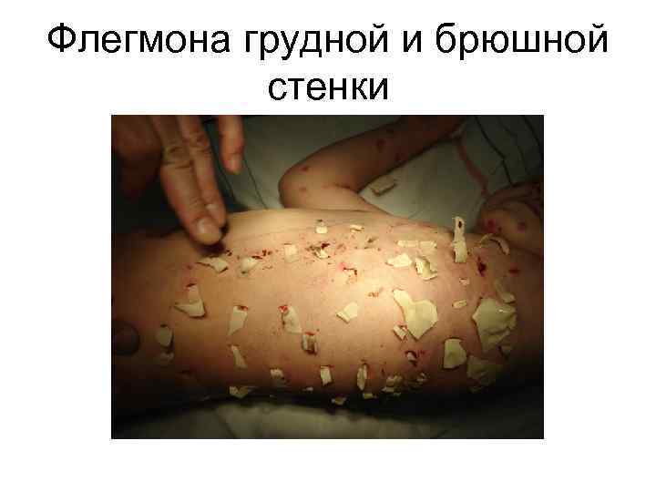 Флегмона грудной и брюшной стенки 