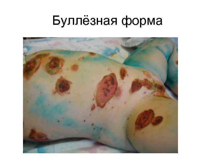 Буллёзная форма 