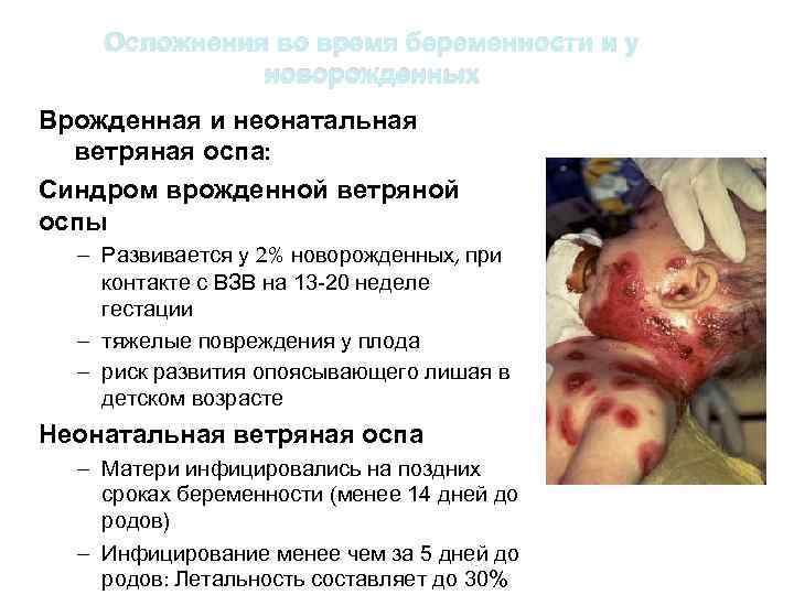 Осложнения во время беременности и у новорожденных Врожденная и неонатальная ветряная оспа: Синдром врожденной