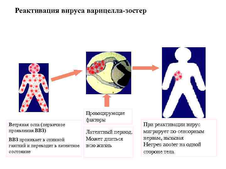 Реактивация вируса варицелла-зостер Ветряная оспа Латентная фаза Ветряная оспа (первичное проявления ВВЗ) ВВЗ проникает