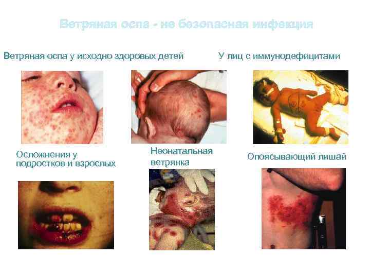 Ветряная оспа - не безопасная инфекция Ветряная оспа у исходно здоровых детей Осложнения у