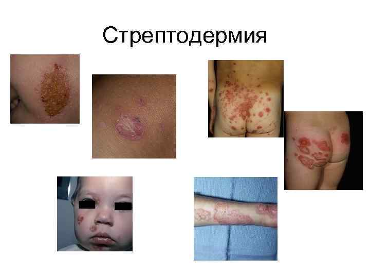 Стрептодермия 
