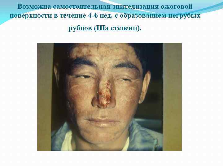 Возможна самостоятельная эпителизация ожоговой поверхности в течение 4 -6 нед. с образованием негрубых рубцов