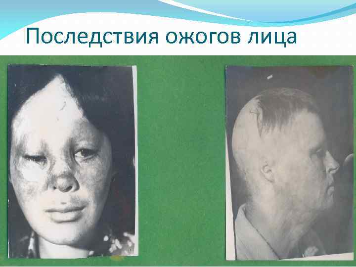 Последствия ожогов лица 