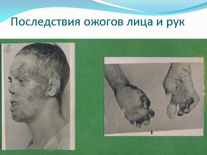 Последствия ожогов лица и рук 