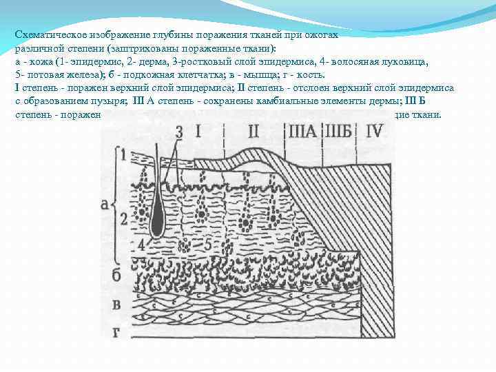 Схематическое изображение глубины поражения тканей при ожогах различной степени (заштрихованы пораженные ткани): а -