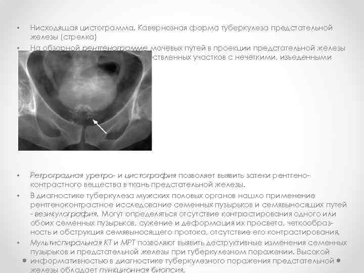  • • • Нисходящая цистограмма. Кавернозная форма туберкулеза предстательной железы (стрелка) На обзорной