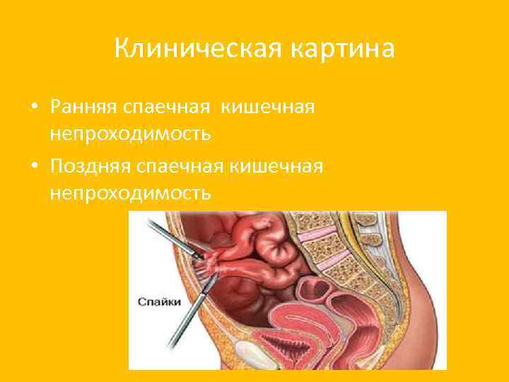 Клиническая картина • Ранняя спаечная кишечная непроходимость • Поздняя спаечная кишечная непроходимость 