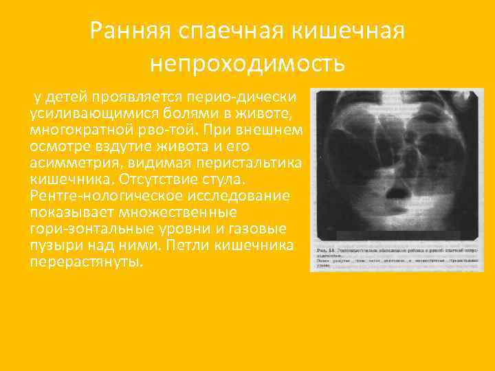 Ранняя спаечная кишечная непроходимость у детей проявляется перио дически усиливающимися болями в животе, многократной