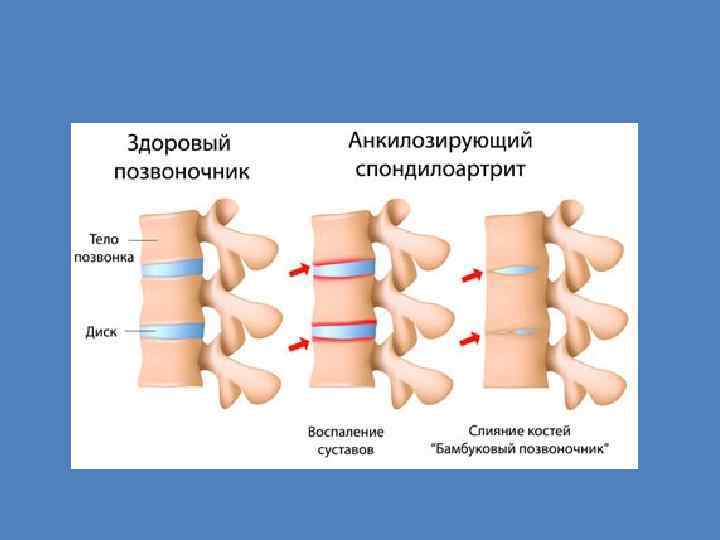 Спондилоартроз лечение медикаментозное. Периферическая форма спондилоартрита. Анкилозирующий спондилоартроз. Анкилозирующий спондилоартрит периферическая форма. Периферический спондилоартрит.