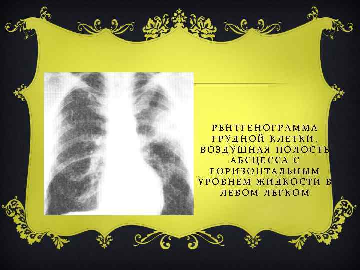 РЕНТГЕНОГРАММА ГРУДНОЙ КЛЕТКИ. ВОЗДУШНАЯ ПОЛОСТЬ АБСЦЕССА С ГОРИЗОНТАЛЬНЫМ УРОВНЕМ ЖИДКОСТИ В ЛЕВОМ ЛЕГКОМ 