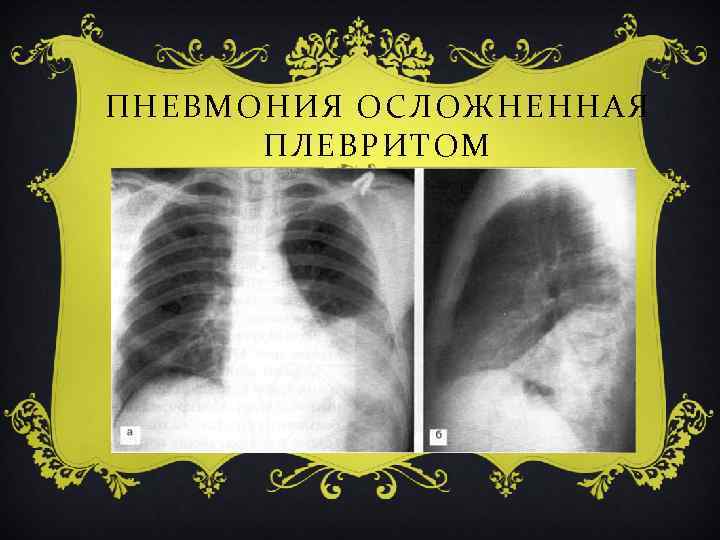 ПНЕВМОНИЯ ОСЛОЖНЕННАЯ ПЛЕВРИТОМ 