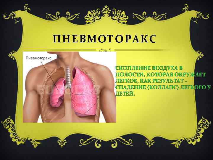 ПНЕВМОТОРАКС 