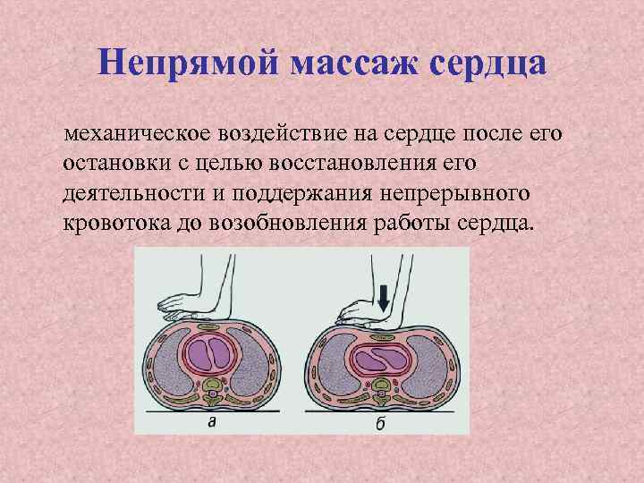 Непрямой массаж сердца механическое воздействие на сердце после его остановки с целью восстановления его