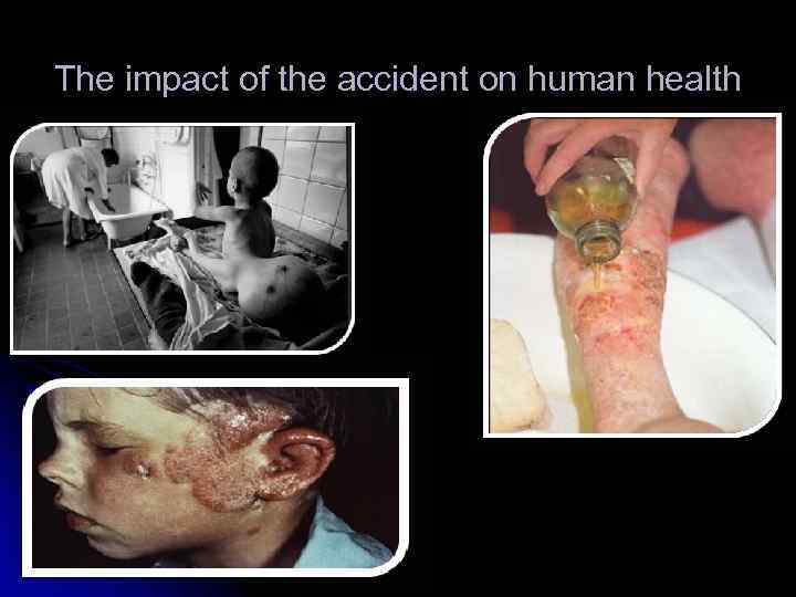 The impact of the accident on human health 