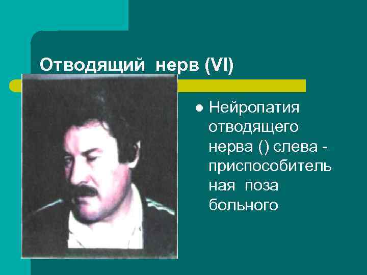 Отводящий нерв (VI) l Нейропатия отводящего нерва () слева приспособитель ная поза больного 