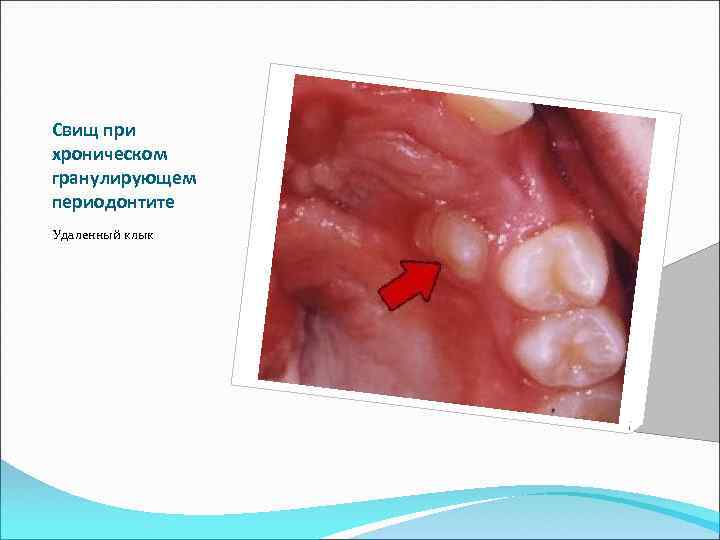 Свищ при хроническом гранулирующем периодонтите Удаленный клык 