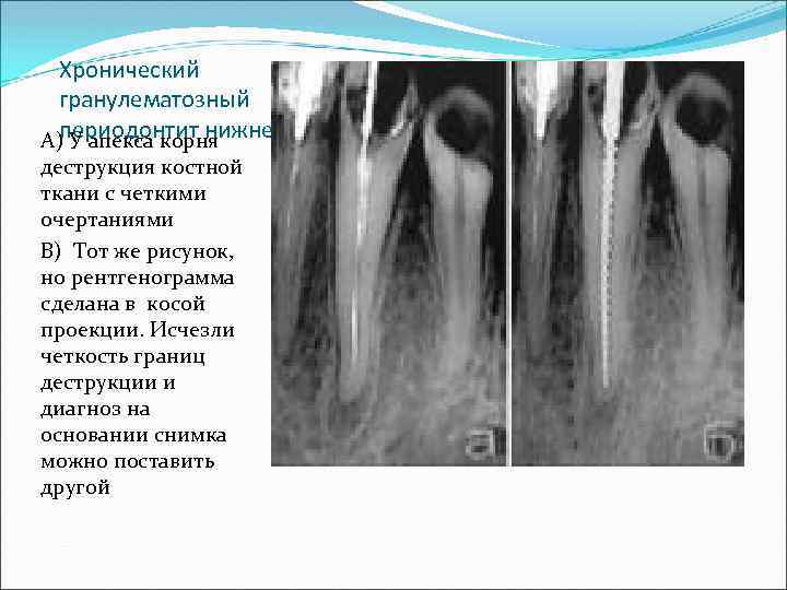 Хронический гранулематозный периодонтит нижнего А) У апекса корня деструкция костной ткани с четкими очертаниями